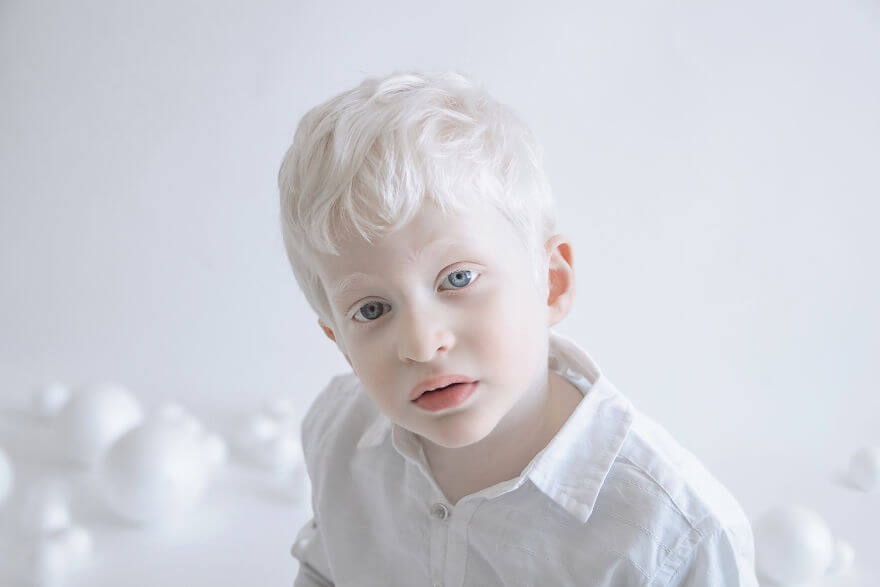 Международный день распространения информации об альбинизме